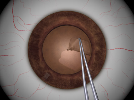 Capsulorhexis With Forceps